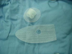 Huntsville Products Liability Attorneys provide information on Hernia Mesh Implants